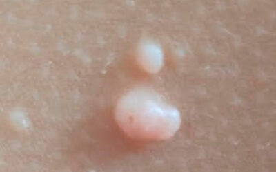 Moluscos contagiosos