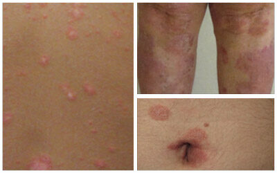 ¿Qué es la psoriasis?