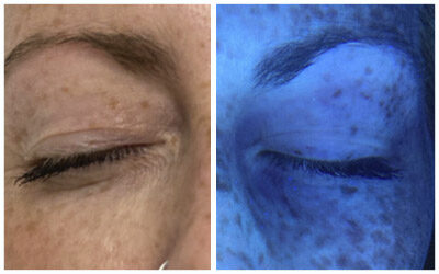 Lámpara de Wood en la consulta de Dermatología