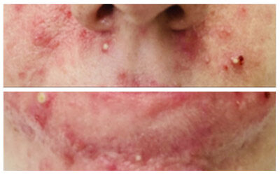 Maskne, el acné de la mascarilla