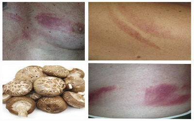 Dermatitis flagelada por Shiitake