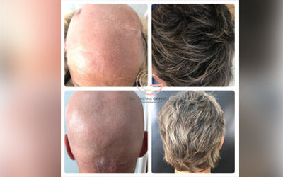 Alopecia areata