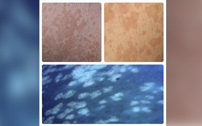 Pitiriasis versicolor
