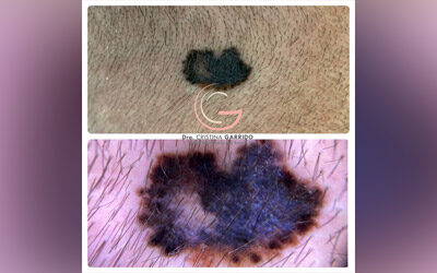Melanoma