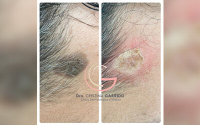 Queratosis seborreicas